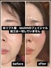上がる！リフティング小顔60コース　毛穴洗浄＋ハイパーパルス＋EMS＋RF