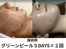 エメ(Eme)の雰囲気（思春期にきびはもちろん、大人ニキビにも◎！ご相談ください★）