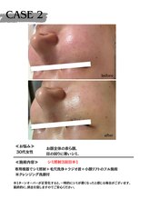 ミウル 天王寺店(miulu)/30代女性/シミ照射2回