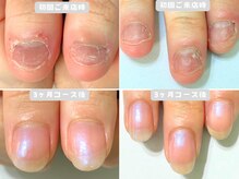 深爪/平らな爪/噛み爪/爪は変わらないと諦めないでくださいね！