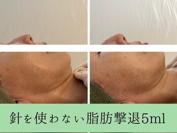 ソルニスデュオ(Solnis.-duo-)/小顔/酵素浴/ハイパーナイフEX2