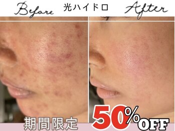 アリュール 倉敷(ALLURE)の写真/素肌に自信が持てる【毛穴の黒ずみ/開き/皮脂/徹底改善◎】繰り返すニキビや長年のニキビでお悩みの方に◎