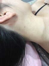エステサロン オパール(OPALE)/えりあし脱毛