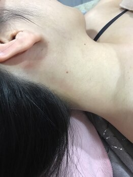 エステサロン オパール(OPALE)/えりあし脱毛