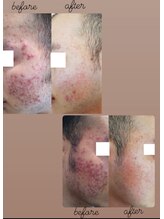 オキシデイスパ 貴志川店/メンズニキビケア改善!!