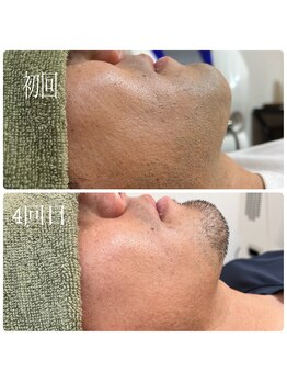 ラフォーレ 岸和田店/デザイン髭脱毛