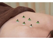 八木整骨院 八木針灸院/お灸の施術