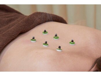 八木整骨院 八木針灸院/お灸の施術