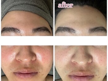 エステティックサロン ベルエトワール住吉店/ハイドロヴィーナス