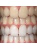 【タイパ重視】医療級ホワイトニング希望の方はこちら！