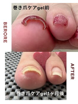 ユーネイル(you NAIL)/巻き爪　ケアジェル