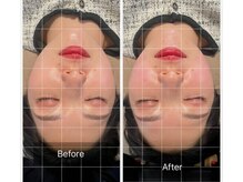 はりきゅう院山小屋/美容鍼でモチ肌に！