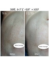 ベルクラージュ(Belle Courage)/30代　シミケア