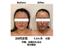 ラナン パラフューズ(Ranun's PARAFUSE.)の雰囲気（たるみ改善で小顔へ♪帽子もサイズダウン♪#小顔仙台）