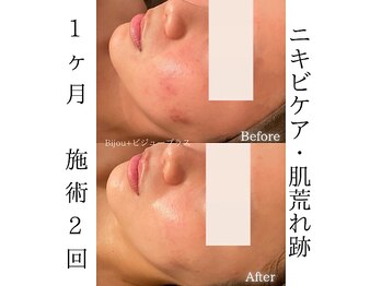ビジュープラス 水戸店(Bijou+)/ニキビケア/肌荒れ跡ケア