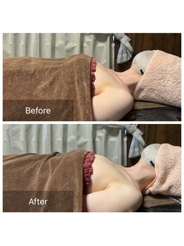 リノレア(LinoLea)/バストアップBefore after