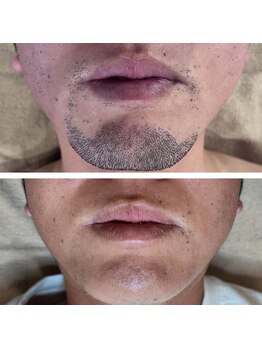 ブリリア(Brillia)/諦めない脱毛の選択肢