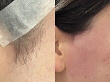 シロ(Shiro)/MIX脱毛もみあげ