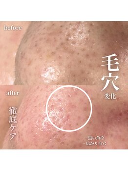 ララ(LaLa.)/毛穴洗浄