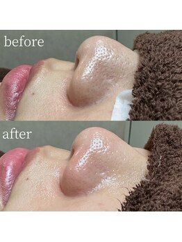 エクラ バイ シャンリィ(eclat by shanLy)/黒ずみ改善