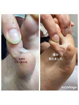 巻き爪補正店 大阪なんば店/+ワンポイント施術