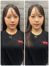 長寿鍼灸院 長寿整骨院/左右非対称のお顔に美容鍼★50本