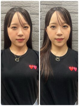 長寿鍼灸院 長寿整骨院/左右非対称のお顔に美容鍼★50本