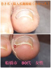 巻き爪じゅん 千葉駅前店/巻き爪・陥入爪施術は痛い？