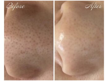 サラスヴァティー(SARASVATI)/毛穴洗浄＆プラズマで引締めまで