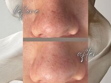 ゴールデンケア(goldencare)/【鼻の毛穴開き、黒ずみ】改善！