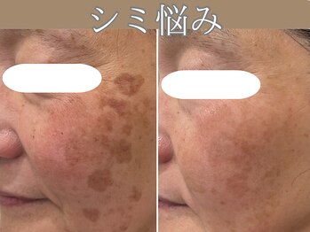 ハウオリ(HAUOLI)/長年の悩みに