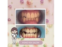 医療提携ホワイトニングで理想の白さに