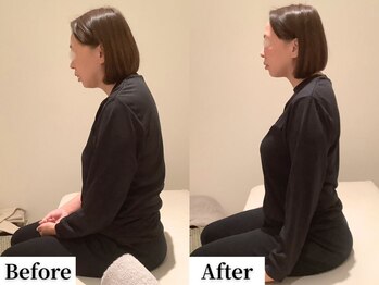 ソレア(Solea)/首・肩こり・巻き肩改善1回目