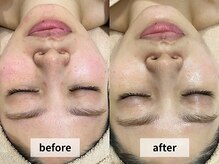 ウェイビーズ エステ(wavy's.esthetic)/【ビフォーアフター】赤味改善