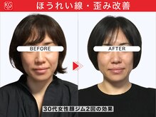 顔ジム 麻布店/30代女性顔ジム1回の効果