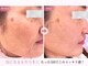 リジェネラティブセル メディカルサロン(Regenerative Cell Medical Salon)の写真/たるみ悩みにサヨナラ！注目の幹細胞培養上清液エクソソームが、輝く未来肌へ導きます☆