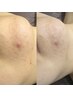 ◯繰り返す肌荒れ・皮脂トラブルに グランIPL×徹底肌質改善 ¥19800