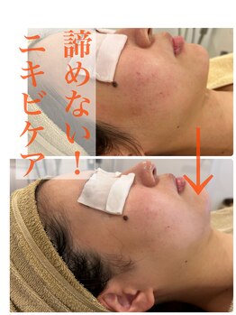 マルコ(marco)/ニキビケア