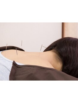 鍼灸施術を受けたい