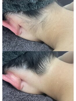 カルディエ(Cardie)/うなじ脱毛　ビフォーアフター