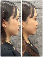 長寿鍼灸院 長寿整骨院/左右非対称のお顔に美容鍼★50本