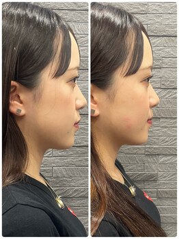 長寿鍼灸院 長寿整骨院/左右非対称のお顔に美容鍼★50本