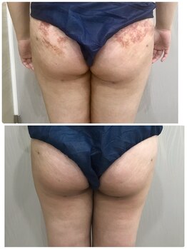 ベルネ(BELLUNE)/術後ケアにはラジオ波が◎