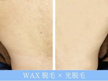 オーシャンブルー 長崎店(OCEAN BLUE)/結果が出る脱毛!背中脱毛