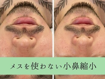 ソルニスデュオ(Solnis.-duo-)/小顔/酵素浴/ハイパーナイフEX2