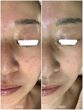 アミィ(amii)/肌育ボンバーフェイシャル