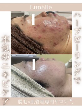 ルネル(Lunelle)/本気のニキビケア☆