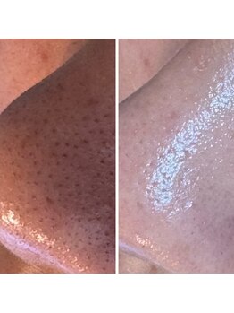 エンチャント(ENCHANT+)の写真/【毛穴洗浄】で黒ずみ毛穴・角栓・いちご鼻をケア！小鼻のザラつきも解消♪