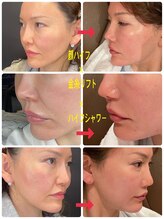 スペチアーレ 夙川/たるみや小じわ改善！