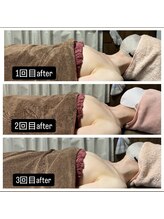 リノレア(LinoLea)/バストアップBefore after